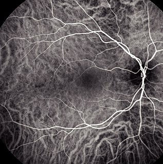 Indocyanine green angiography