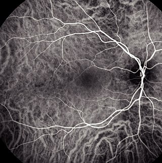 <span class="mw-page-title-main">Indocyanine green angiography</span> Diagnostic procedure