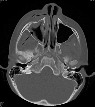 <span class="mw-page-title-main">Periorbital cellulitis</span> Medical condition