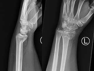 <span class="mw-page-title-main">Smith's fracture</span> Medical condition