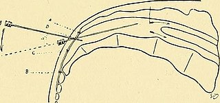 <span class="mw-page-title-main">Caudal anaesthesia</span> Form of neuraxial regional anaesthesia