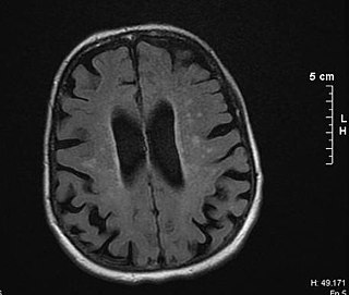 <span class="mw-page-title-main">Binswanger's disease</span> Medical condition