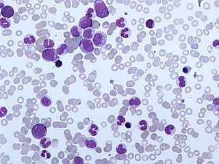 <span class="mw-page-title-main">Chronic myelomonocytic leukemia</span> Medical condition