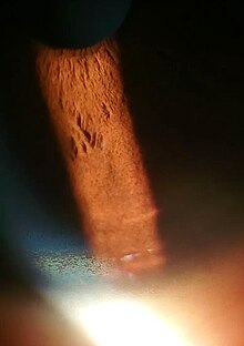 Copper disposition on corneal Descemet's membrane KF ring 2.jpg