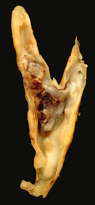 <span class="mw-page-title-main">Carotid endarterectomy</span> Surgical procedure