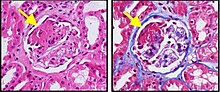 A renal biopsy from a patient with anti-neutrophil cytoplasmic antibody (ANCA)-associated glomerulonephritis reveals a lesion characterized by bright eosinophilia on H&E staining (yellow arrow, left) and intense red staining with trichrome (right), confirming the presence of fibrinoid necrosis. Fibrinoid necrosis.jpg