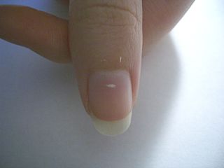 <span class="mw-page-title-main">Leukonychia</span> White spots on finger and toe nails