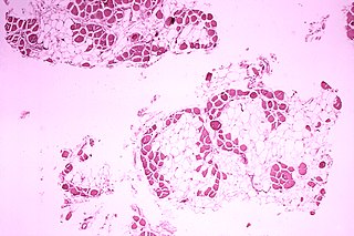 <span class="mw-page-title-main">Duchenne muscular dystrophy</span> Type of muscular dystrophy