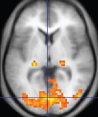 <span class="mw-page-title-main">Functional magnetic resonance imaging</span> MRI procedure that measures brain activity by detecting associated changes in blood flow