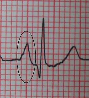 Right atrial enlargement