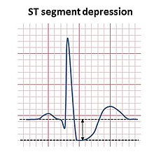 Illustration of upsloping ST segment depression ST depression illustration.jpg