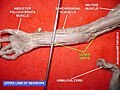 Thần kinh trụ (Ulnar nerve)