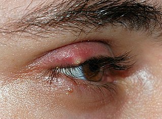 <span class="mw-page-title-main">Stye</span> Medical condition