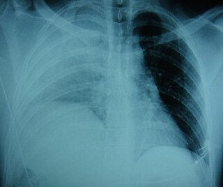 <span class="mw-page-title-main">Diaphragmatic rupture</span> Tear in the thoracic diaphragm, usually caused by physical trauma