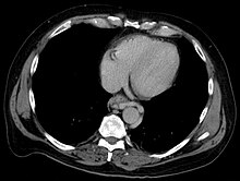 Axial CT showing esophageal varices in liver cirrhosis with portal hypertension Oesophagusvarizen 02.jpg