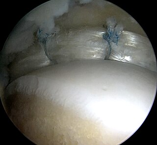 <span class="mw-page-title-main">Labral reconstruction</span> Medical procedure