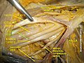 Thần kinh trụ (Ulnar nerve)