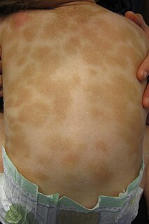 Urticaria pigmentosa Most common form of cutaneous mastocytosis