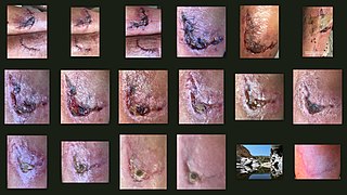 <span class="mw-page-title-main">Wound healing</span> Series of events that restore integrity to damaged tissue after an injury