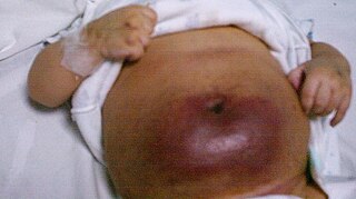 Kasabach–Merritt syndrome A rare disease usually seen in infants