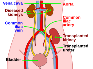 <span class="mw-page-title-main">Kidney transplantation</span> Medical procedure