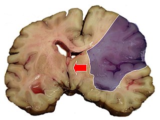 <span class="mw-page-title-main">Midline shift</span> Sideways displacement of the brain