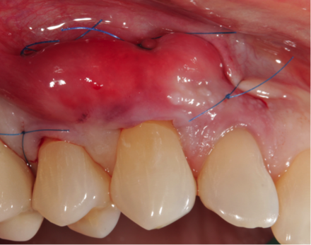 Gums sutured during a graft Sutures-fig-5.png