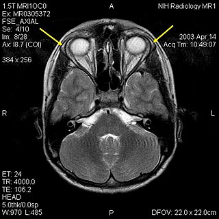 <span class="mw-page-title-main">Triple-A syndrome</span> Medical condition