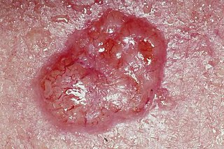 <span class="mw-page-title-main">Skin cancer</span> Medical condition involving uncontrolled growth of skin cells