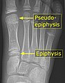 Metatarsal pseudo-epiphysis.jpg