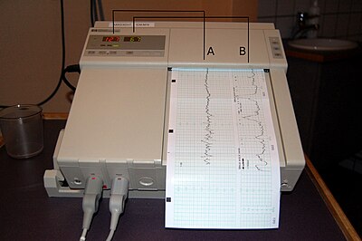 Schematic explanation of cardiotocography: heart rate (A) is calculated from fetal heart motion determined by ultrasound, and uterine contractions are measured by a tocodynamometer (B). These numbers are represented on a time scale with the help of a running piece of paper, producing a graphical representation. Cardiotocography diagram.jpg