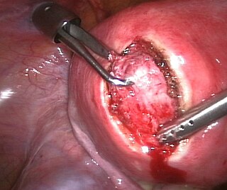 <span class="mw-page-title-main">Uterine myomectomy</span> Surgical removal of uterine fibroid