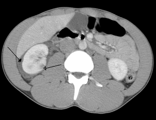 <span class="mw-page-title-main">Abdominal trauma</span> Medical condition