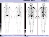 Ganzkörperknochenszintigramm mit 99mTc-HDP der Patientin mit der Oberarmfraktur aufgrund einer Brustkrebsmetastase