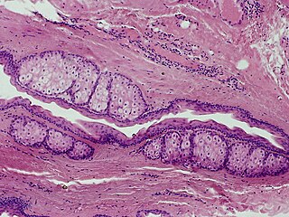 <span class="mw-page-title-main">Steatocystoma multiplex</span> Medical condition