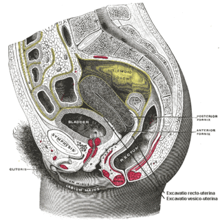 <span class="mw-page-title-main">Rectocele</span> Bulging of the rectum into the vaginal wall