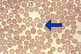 Babesiosis