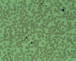 <span class="mw-page-title-main">Thalassemia</span> Medical condition