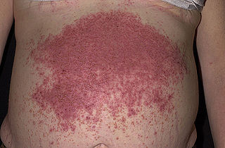 <span class="mw-page-title-main">Dermatitis herpetiformis</span> Chronic autoimmune disorder leading to blistering skin