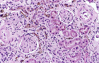 <span class="mw-page-title-main">Hemosiderosis</span> Iron metabolism disease