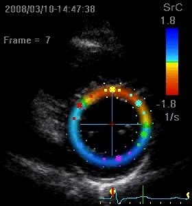 <span class="mw-page-title-main">Speckle tracking echocardiography</span>