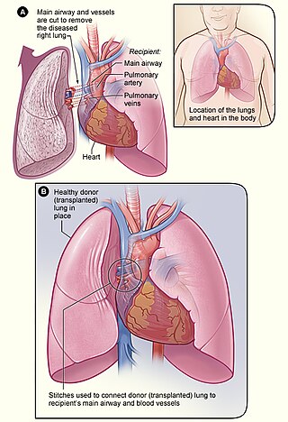 <span class="mw-page-title-main">Lung transplantation</span> Surgical procedure in which a patients diseased lungs are partially or totally replaced