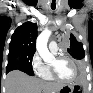 <span class="mw-page-title-main">Mesothelioma</span> Cancer associated with asbestos