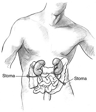 <span class="mw-page-title-main">Ureterostomy</span>