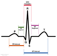 Schematic diagram of normal sinus rhythm for a human heart as seen on an electrocardiogram. SinusRhythmLabels.png