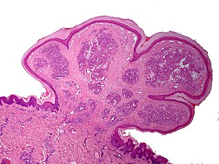 Pyogenic granuloma