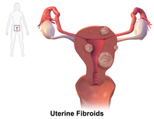 Uterine leiomyoma Uterine Fibroids.png