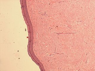 <span class="mw-page-title-main">Neurothekeoma</span>