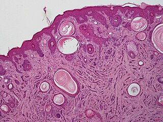 Microcystic adnexal carcinoma