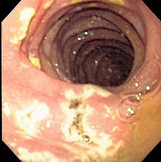 <span class="mw-page-title-main">Zollinger–Ellison syndrome</span> Condition in which tumours stimulate excessive gastric acid production